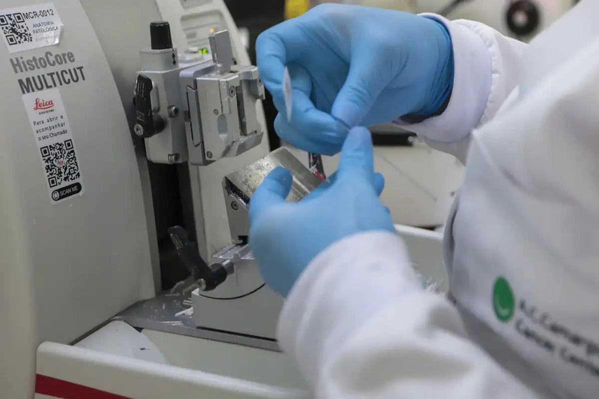 SUS incorpora novo tratamento para pacientes com leucemia mieloide aguda