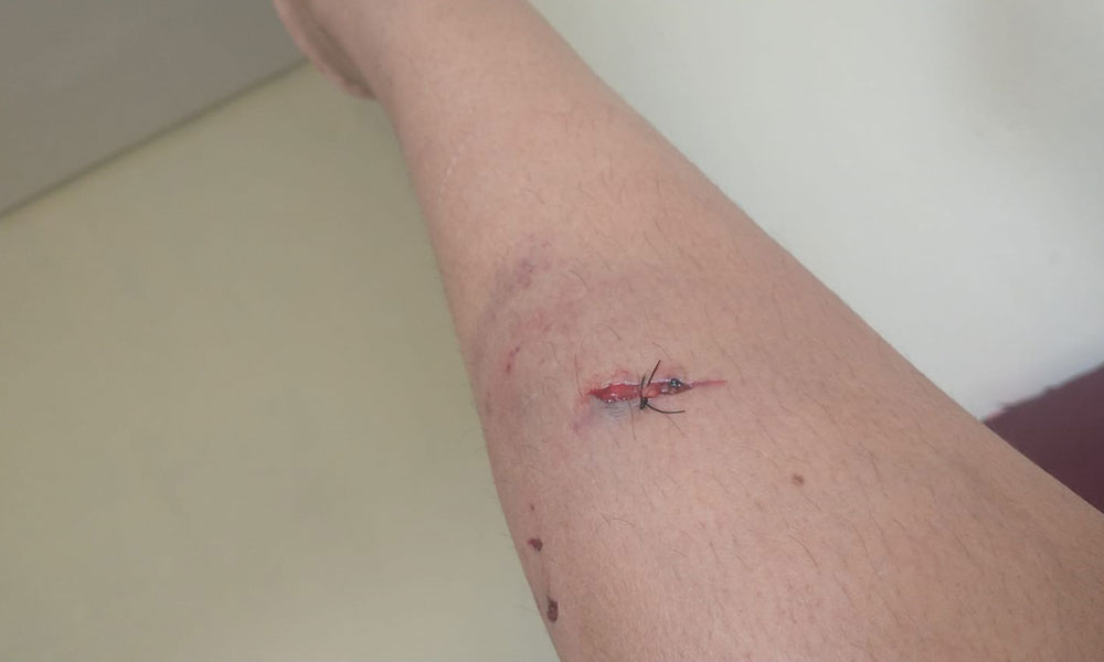 Moradora é atacada por cão de rua em Livramento de Nossa Senhora