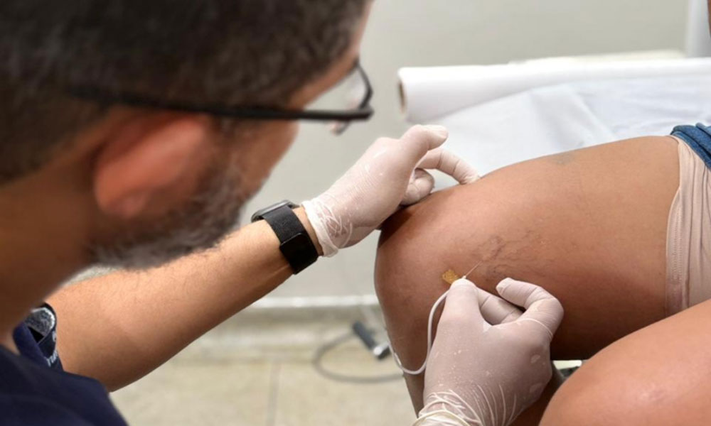 Prefeitura de Livramento inicia atendimentos para tratamento de varizes após triagem vascular
